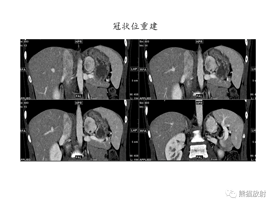 影像PPT - 【病例】肾上腺占位两例—腺瘤VS嗜铬细胞瘤CT及MR-15
