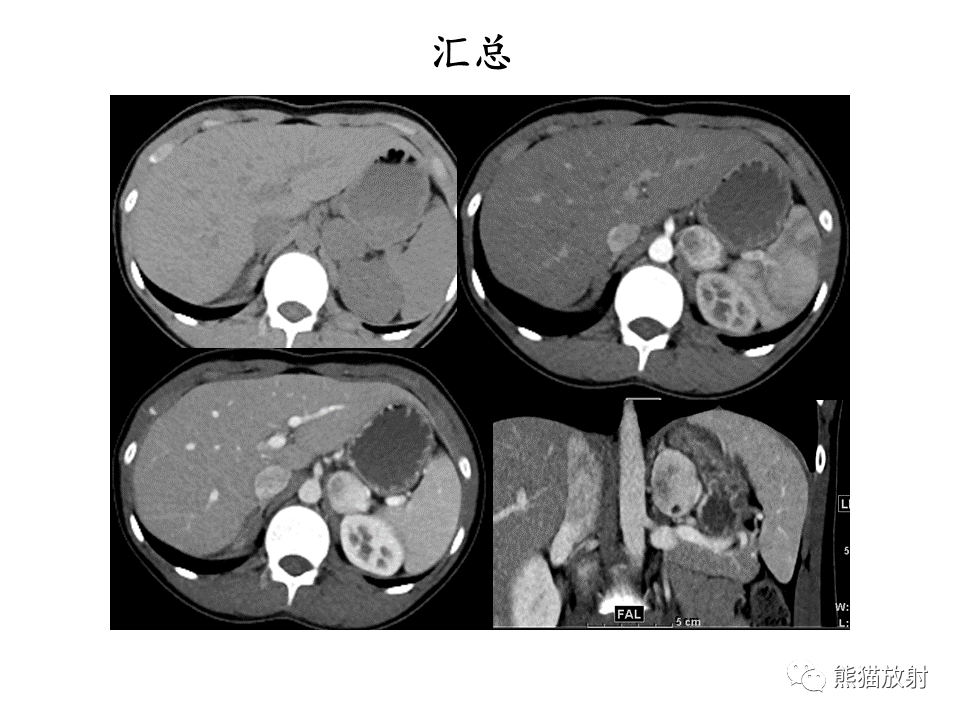 影像PPT - 【病例】肾上腺占位两例—腺瘤VS嗜铬细胞瘤CT及MR-16