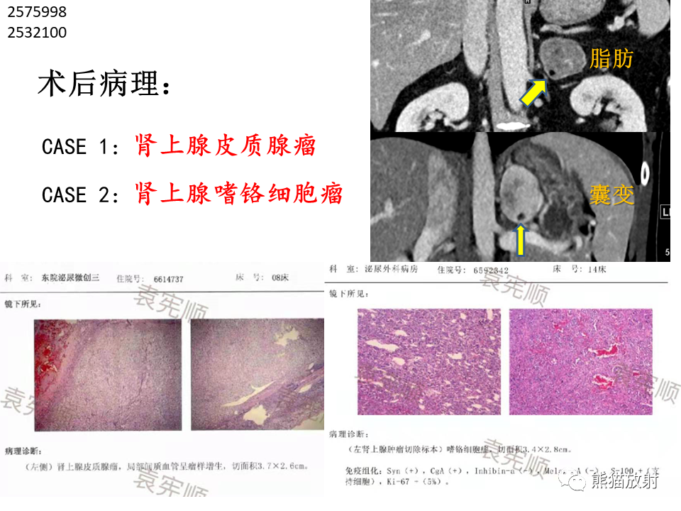 影像PPT - 【病例】肾上腺占位两例—腺瘤VS嗜铬细胞瘤CT及MR-18
