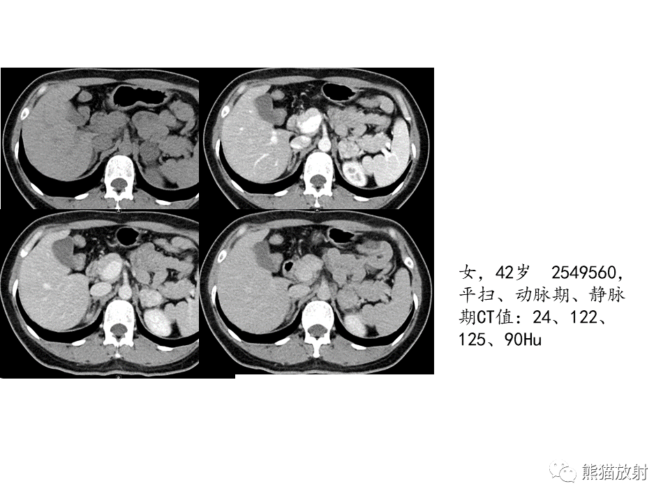 影像PPT - 【病例】肾上腺占位两例—腺瘤VS嗜铬细胞瘤CT及MR-22