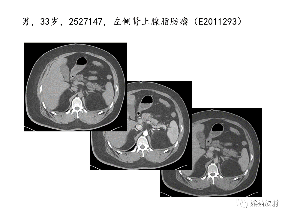影像PPT - 【病例】肾上腺占位两例—腺瘤VS嗜铬细胞瘤CT及MR-29