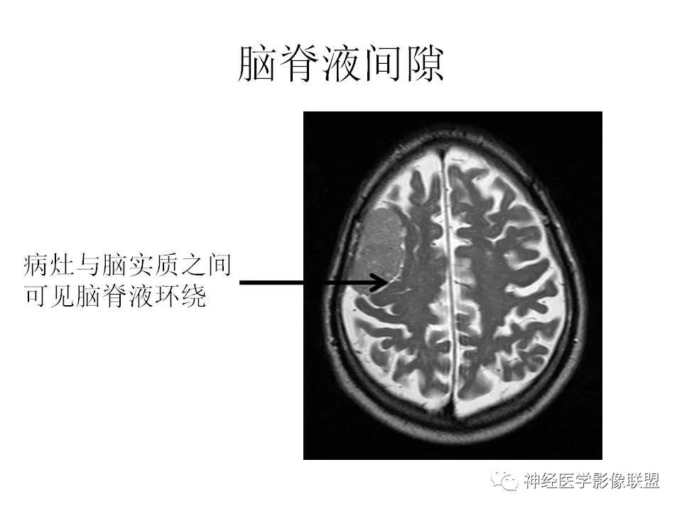 影像PPT - 脑膜三件套——脑膜瘤,HPC/SFT-1 影像PPT - 脑膜三件套——脑膜瘤,HPC/SFT-1