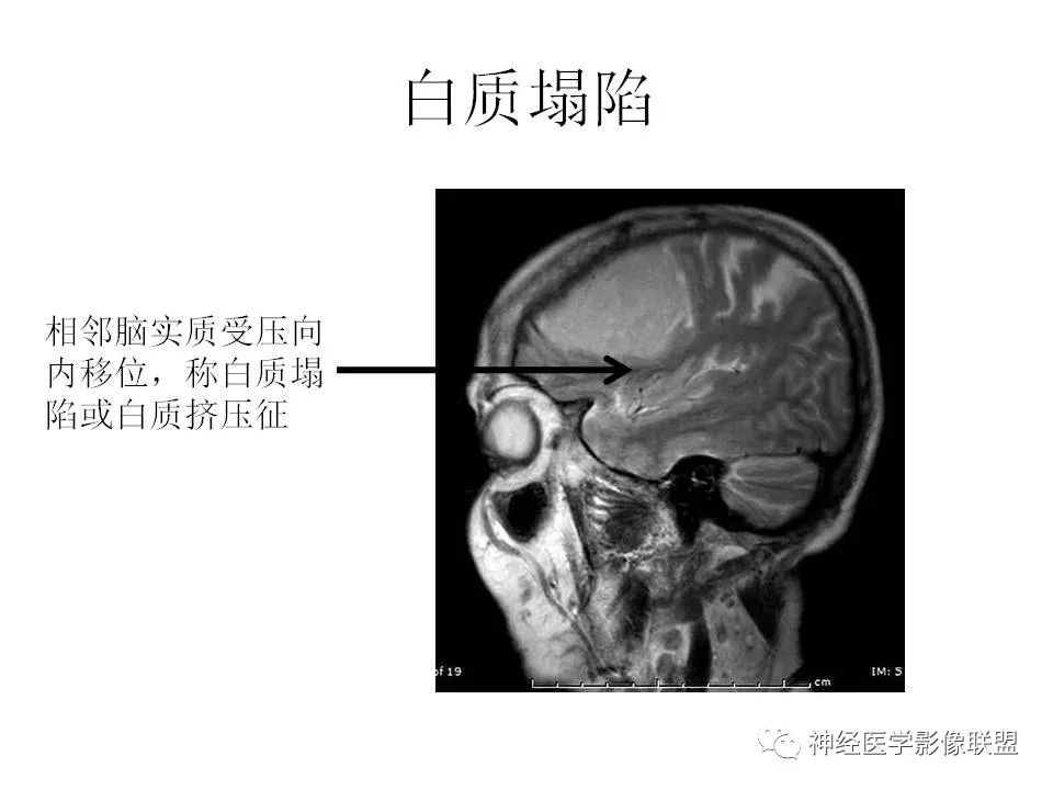 影像PPT - 脑膜三件套——脑膜瘤,HPC/SFT-3 影像PPT - 脑膜三件套——脑膜瘤,HPC/SFT-3