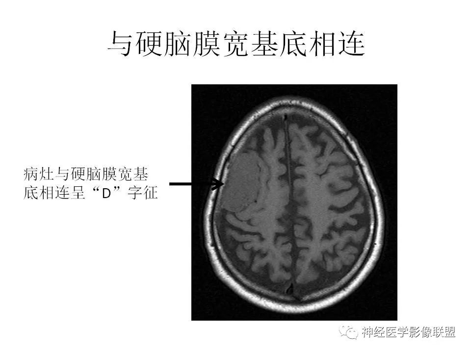影像PPT - 脑膜三件套——脑膜瘤,HPC/SFT-4 影像PPT - 脑膜三件套——脑膜瘤,HPC/SFT-4