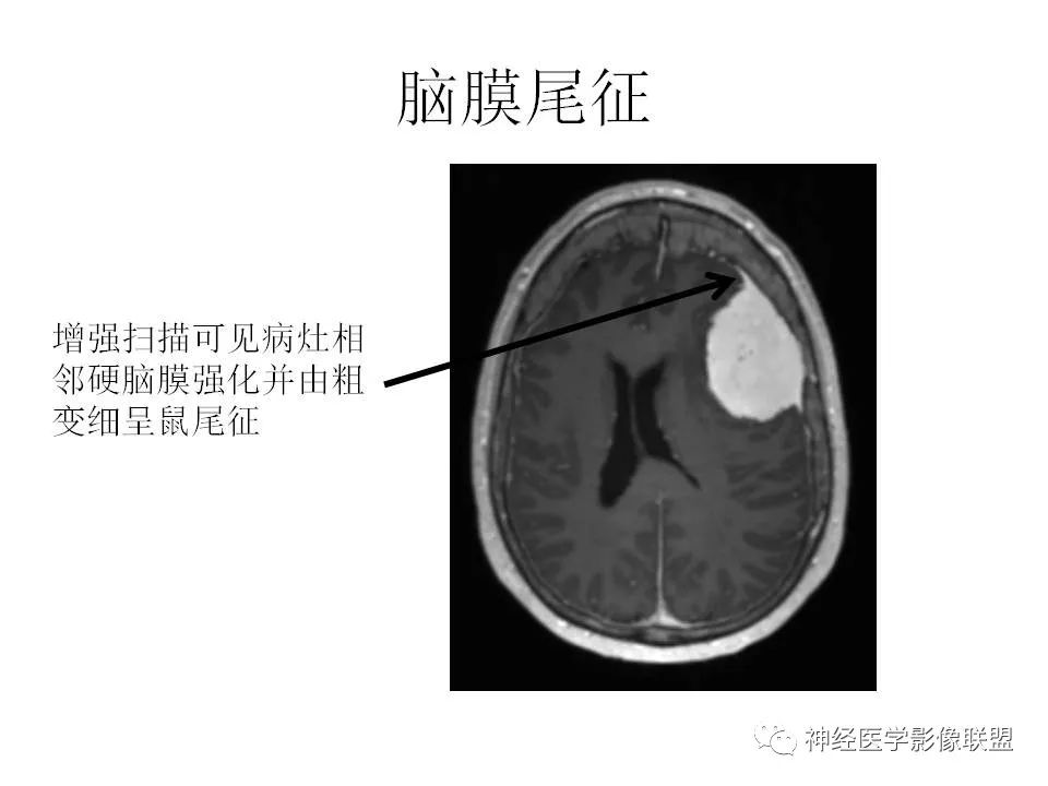 影像PPT - 脑膜三件套——脑膜瘤,HPC/SFT-5 影像PPT - 脑膜三件套——脑膜瘤,HPC/SFT-5