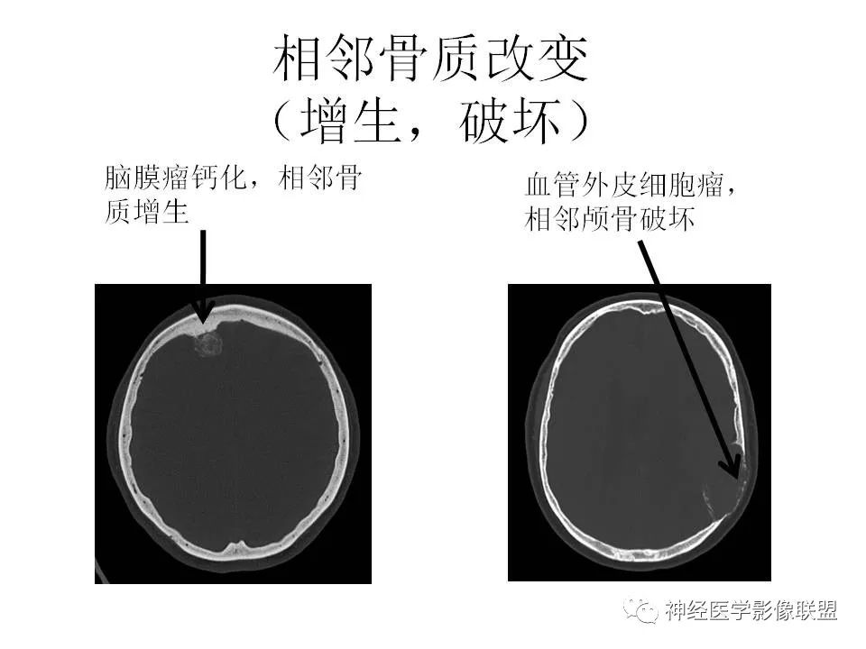 影像PPT - 脑膜三件套——脑膜瘤,HPC/SFT-6 影像PPT - 脑膜三件套——脑膜瘤,HPC/SFT-6