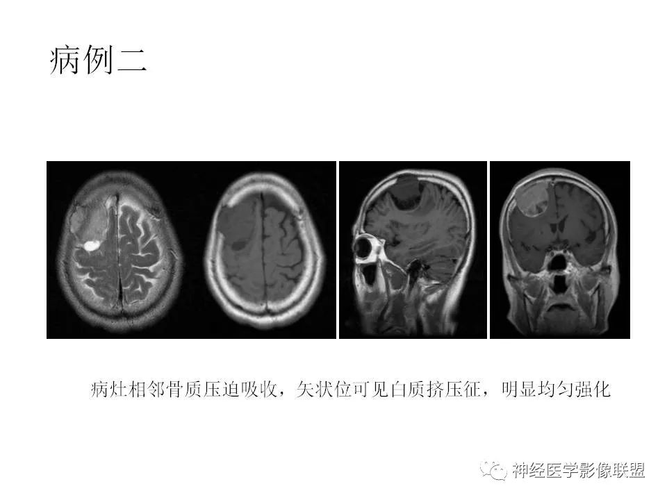 影像PPT - 脑膜三件套——脑膜瘤,HPC/SFT-7 影像PPT - 脑膜三件套——脑膜瘤,HPC/SFT-7