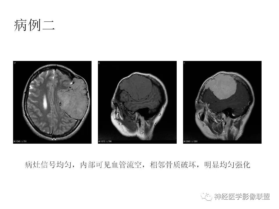 影像PPT - 脑膜三件套——脑膜瘤,HPC/SFT-8 影像PPT - 脑膜三件套——脑膜瘤,HPC/SFT-8