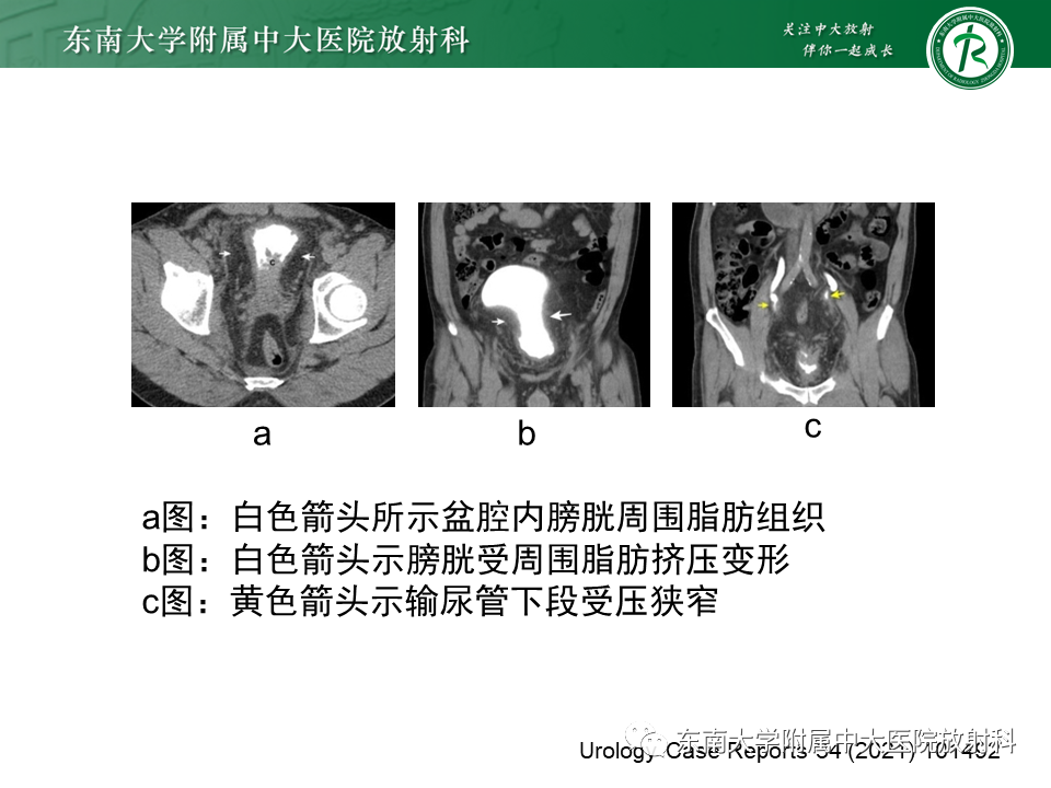 影像PPT - 【病例】盆腔脂肪增多症1例CT影像-11