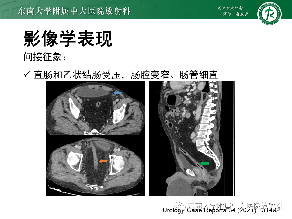 影像PPT - 【病例】盆腔脂肪增多症1例CT影像-12
