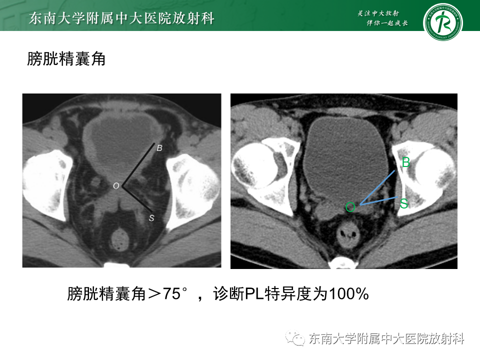 影像PPT - 【病例】盆腔脂肪增多症1例CT影像-13