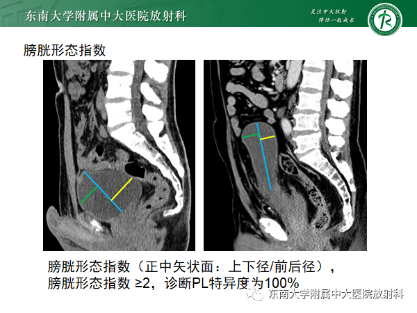 影像PPT - 【病例】盆腔脂肪增多症1例CT影像-14