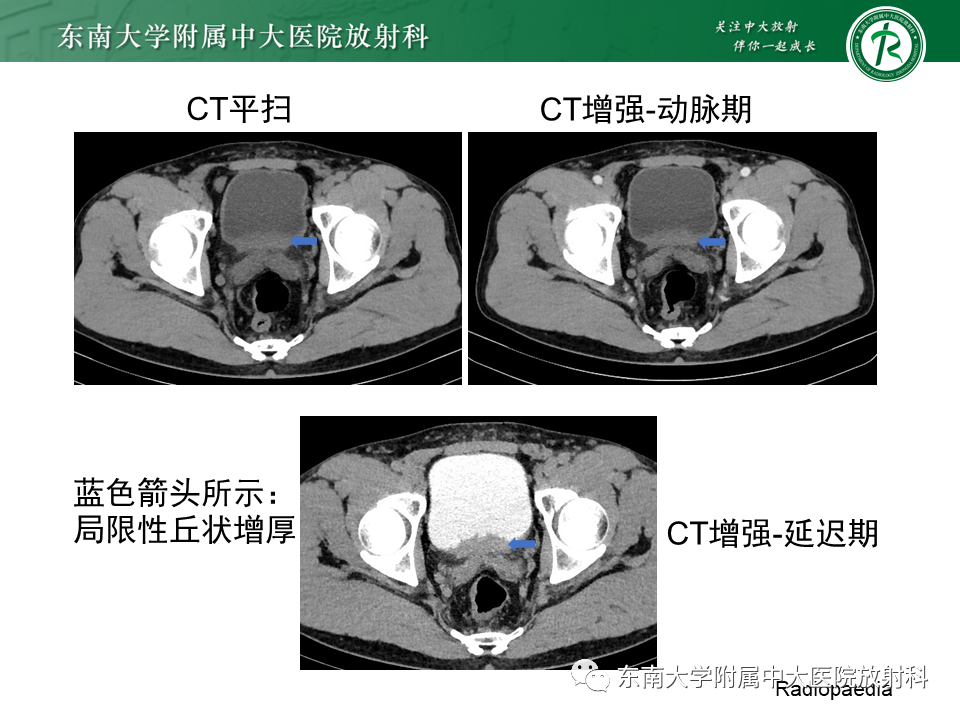 影像PPT - 【病例】盆腔脂肪增多症1例CT影像-17