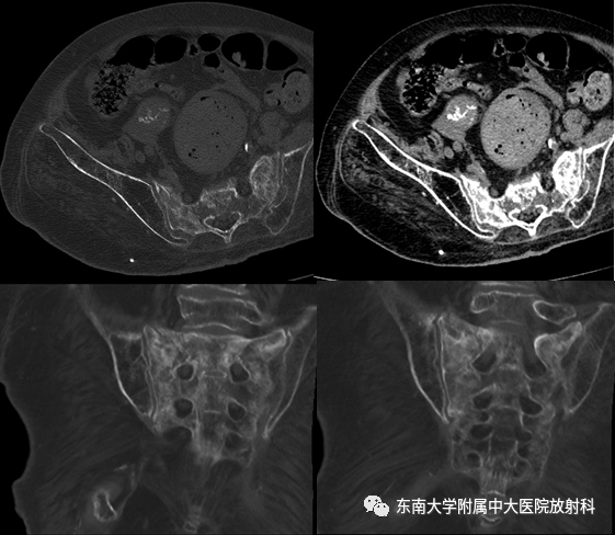 影像PPT - 【病例】骶骨衰竭骨折（不全骨折）1例CT及MR影像-1