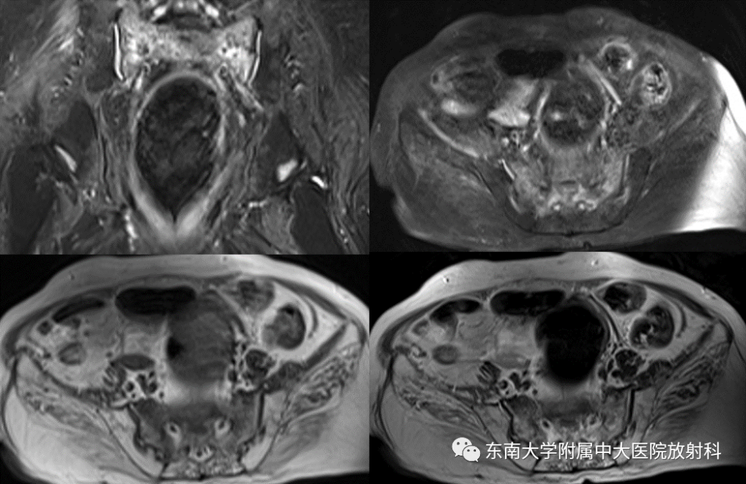 影像PPT - 【病例】骶骨衰竭骨折（不全骨折）1例CT及MR影像-2