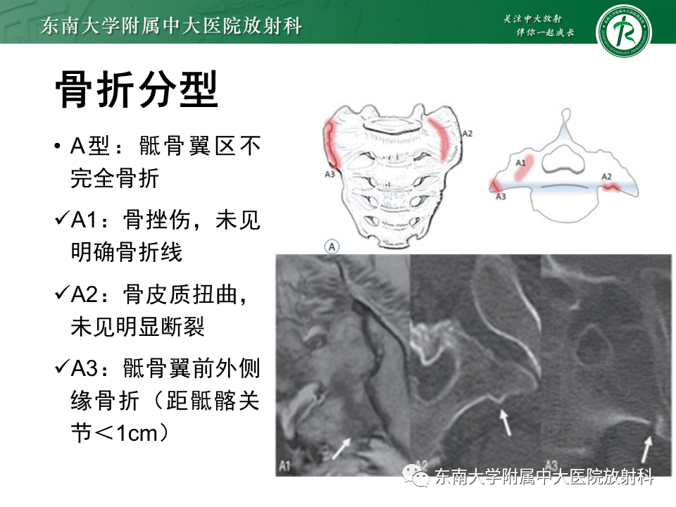 影像PPT - 【病例】骶骨衰竭骨折（不全骨折）1例CT及MR影像-10