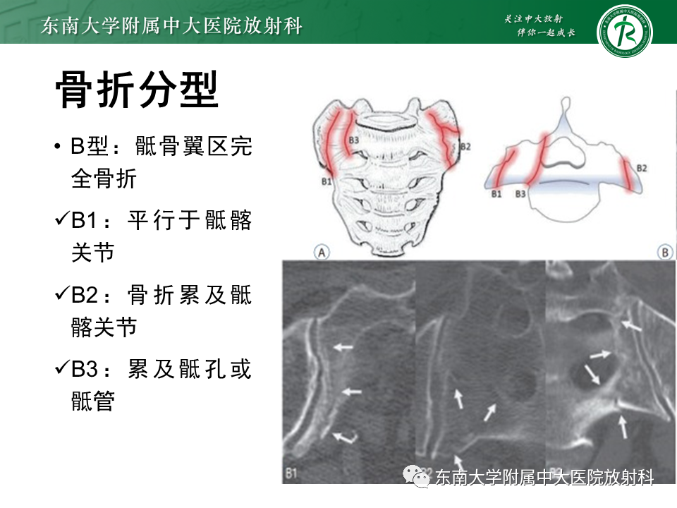 影像PPT - 【病例】骶骨衰竭骨折（不全骨折）1例CT及MR影像-11