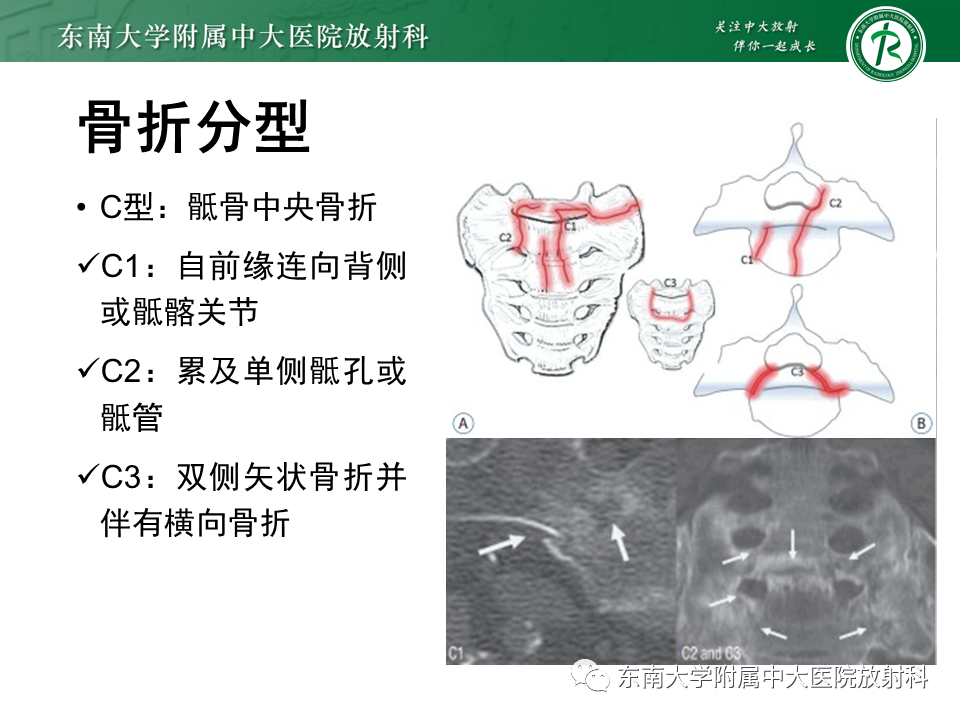 影像PPT - 【病例】骶骨衰竭骨折（不全骨折）1例CT及MR影像-12