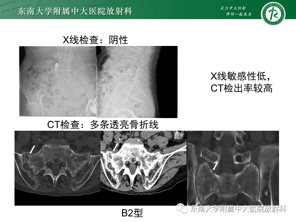 影像PPT - 【病例】骶骨衰竭骨折（不全骨折）1例CT及MR影像-14