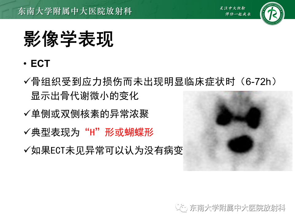 影像PPT - 【病例】骶骨衰竭骨折（不全骨折）1例CT及MR影像-16