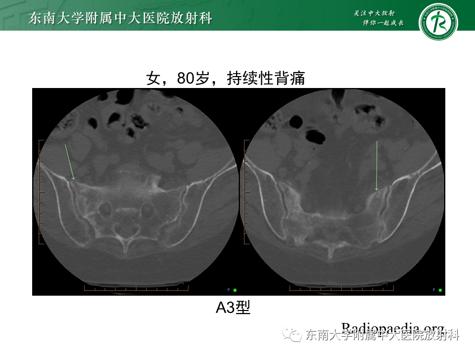 影像PPT - 【病例】骶骨衰竭骨折（不全骨折）1例CT及MR影像-17