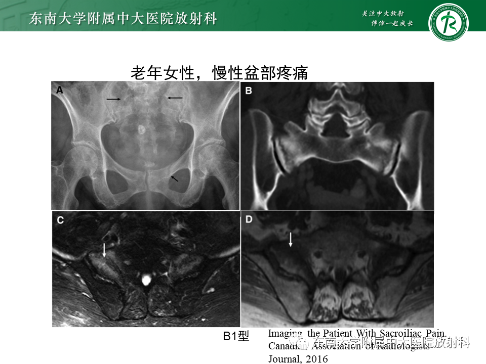影像PPT - 【病例】骶骨衰竭骨折（不全骨折）1例CT及MR影像-18