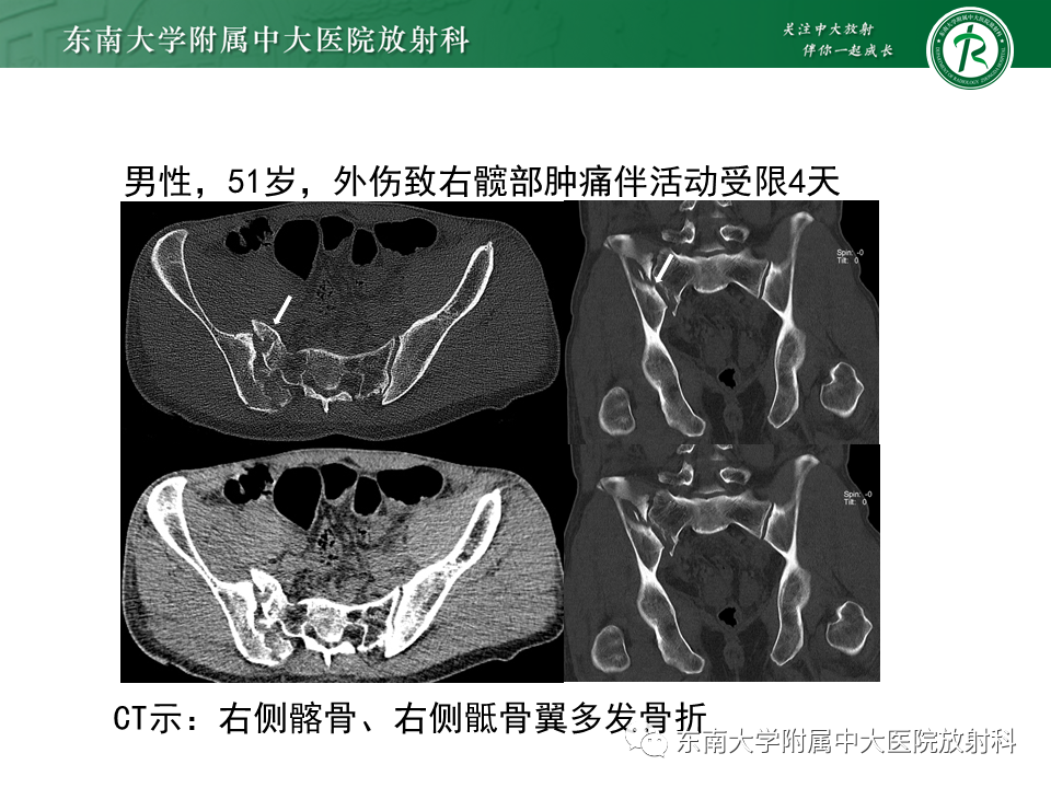 影像PPT - 【病例】骶骨衰竭骨折（不全骨折）1例CT及MR影像-21