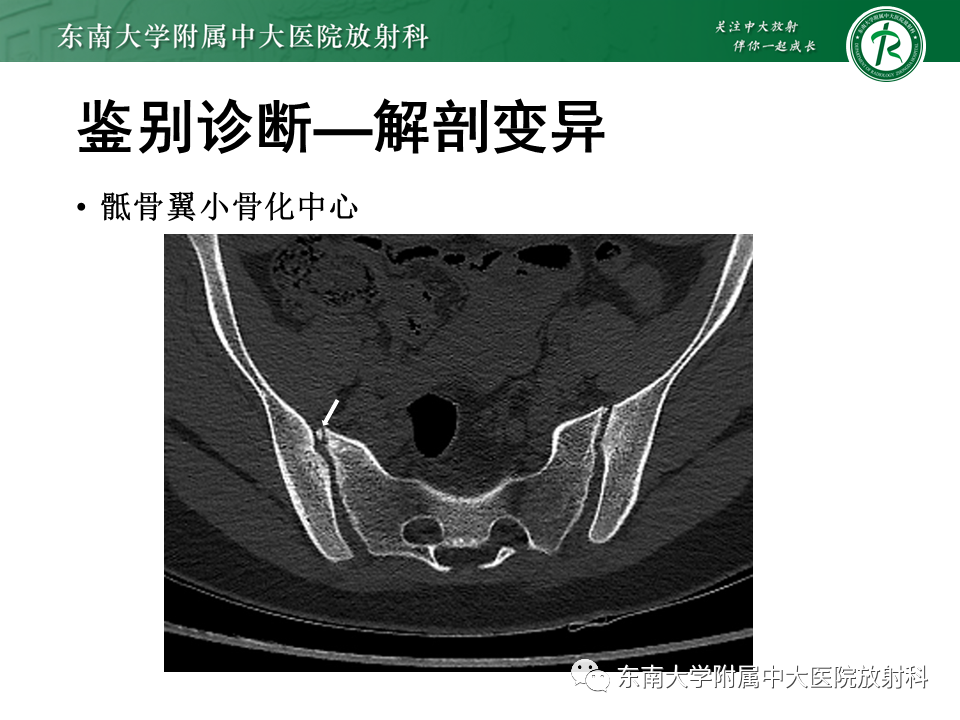 影像PPT - 【病例】骶骨衰竭骨折（不全骨折）1例CT及MR影像-22
