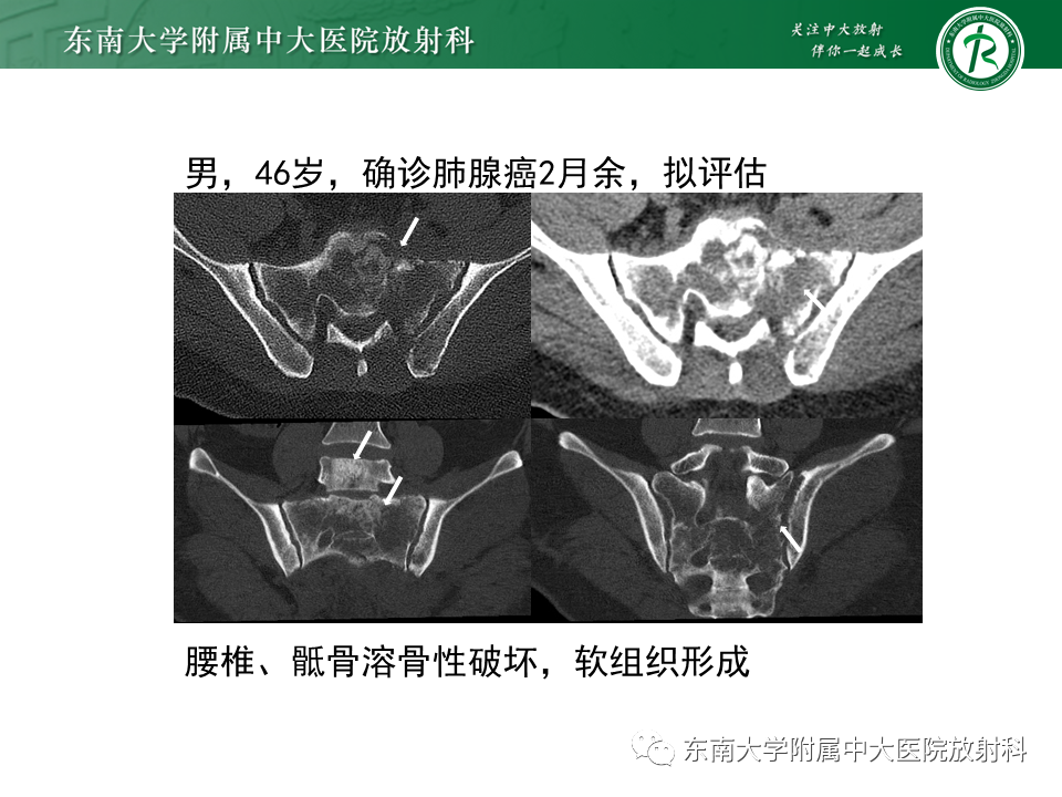 影像PPT - 【病例】骶骨衰竭骨折（不全骨折）1例CT及MR影像-24