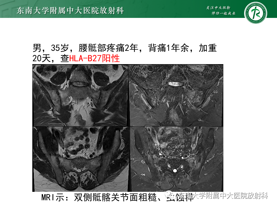 影像PPT - 【病例】骶骨衰竭骨折（不全骨折）1例CT及MR影像-26