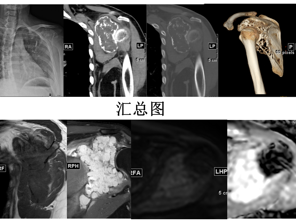影像PPT - 【病例】软骨肉瘤2例X线CT及MR影像-26