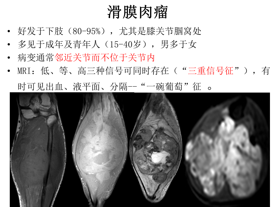影像PPT - 【病例】软骨肉瘤2例X线CT及MR影像-36