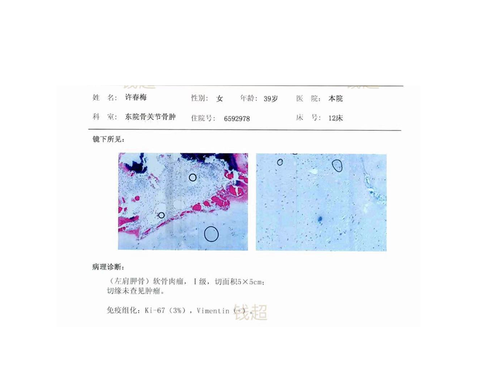 影像PPT - 【病例】软骨肉瘤2例X线CT及MR影像-37