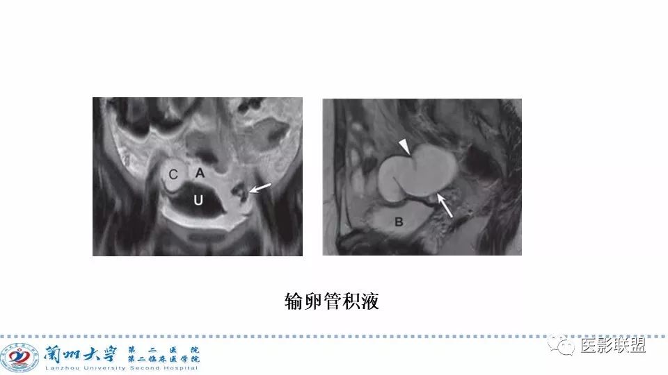影像PPT - 【PPT】卵巢肿瘤MRI诊断-11