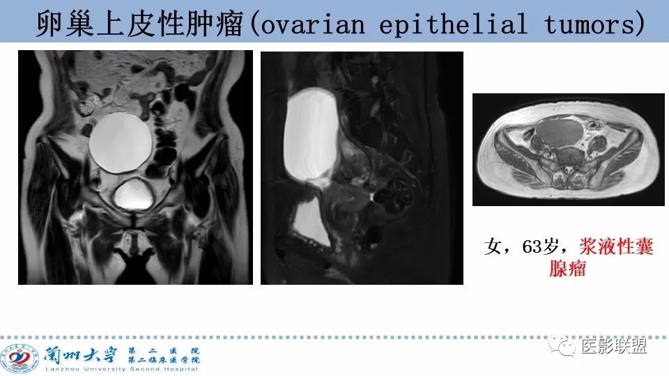 影像PPT - 【PPT】卵巢肿瘤MRI诊断-13