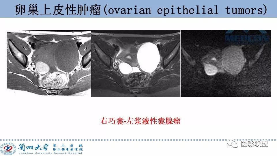 影像PPT - 【PPT】卵巢肿瘤MRI诊断-14