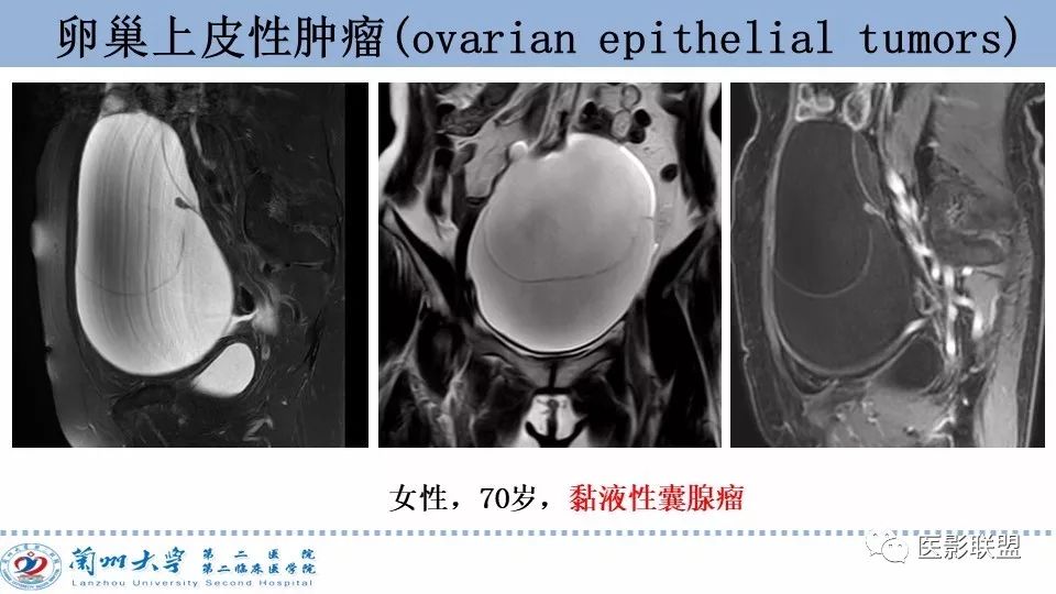 影像PPT - 【PPT】卵巢肿瘤MRI诊断-16