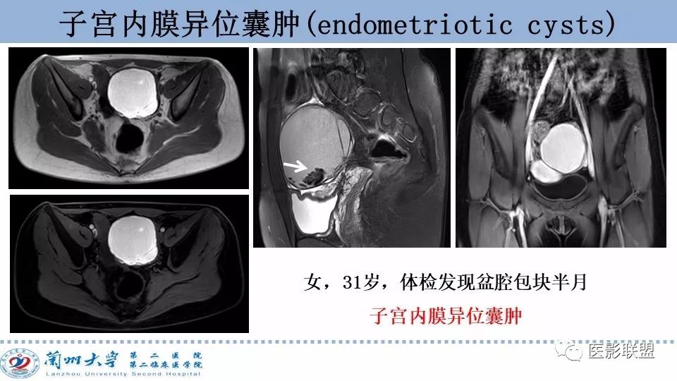 影像PPT - 【PPT】卵巢肿瘤MRI诊断-17