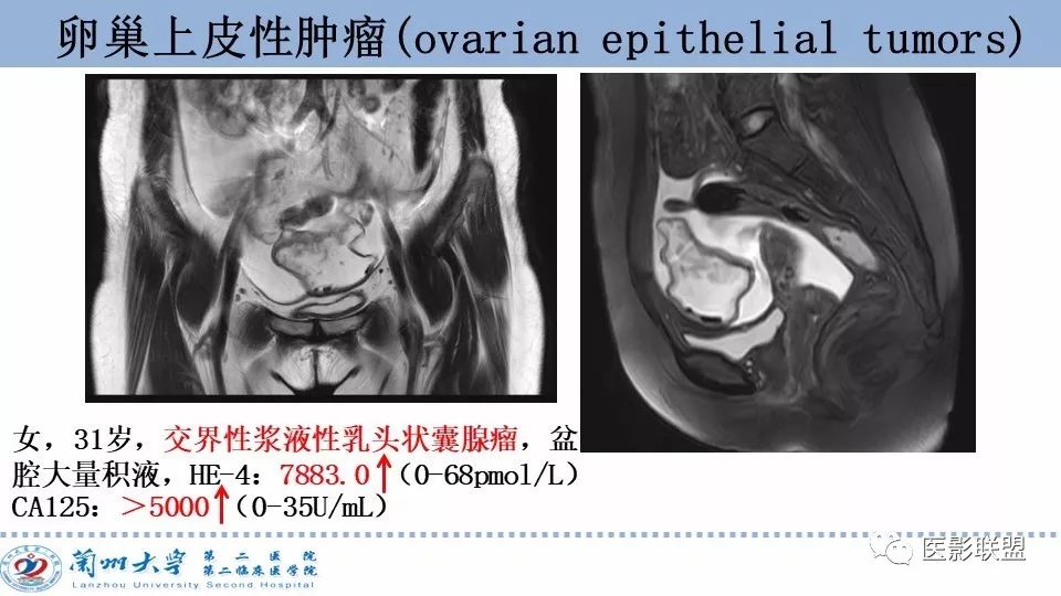 影像PPT - 【PPT】卵巢肿瘤MRI诊断-18