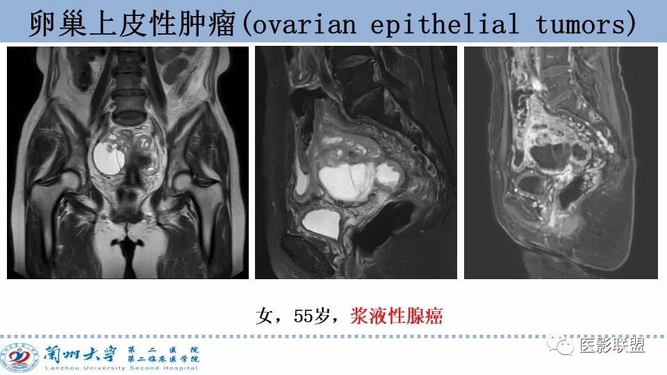 影像PPT - 【PPT】卵巢肿瘤MRI诊断-20