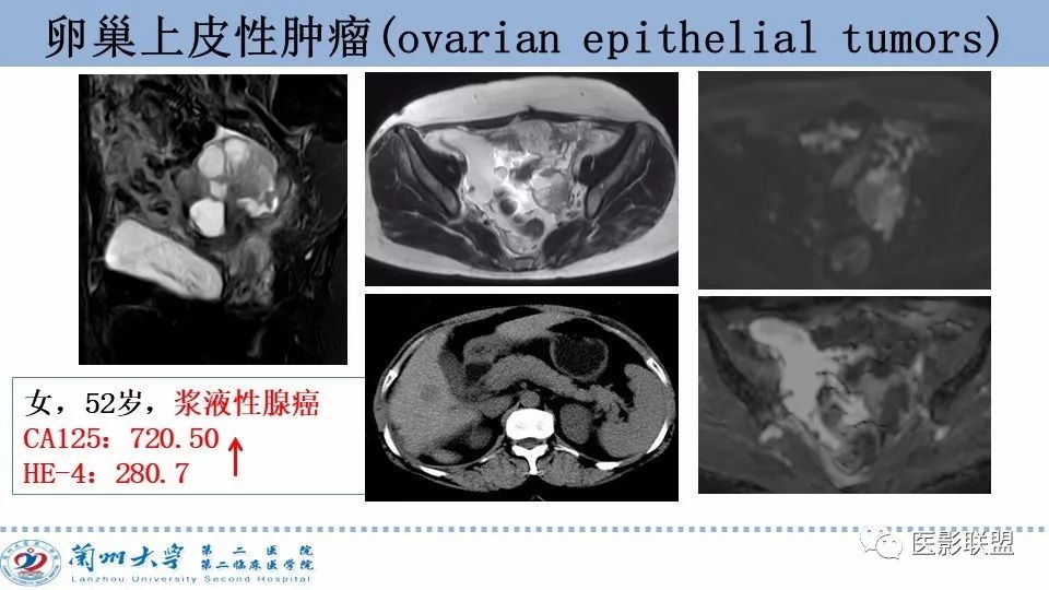 影像PPT - 【PPT】卵巢肿瘤MRI诊断-21