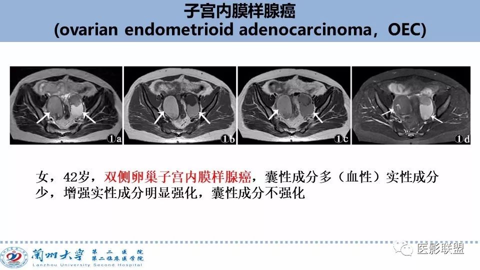 影像PPT - 【PPT】卵巢肿瘤MRI诊断-23
