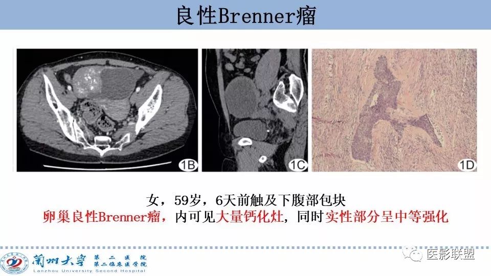 影像PPT - 【PPT】卵巢肿瘤MRI诊断-28