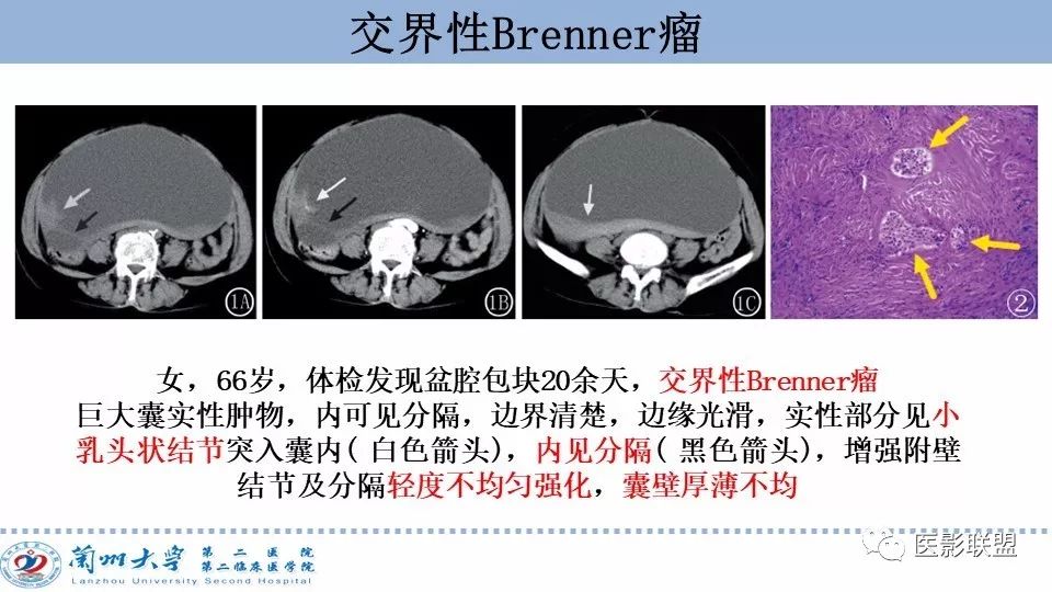 影像PPT - 【PPT】卵巢肿瘤MRI诊断-29