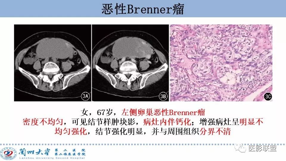 影像PPT - 【PPT】卵巢肿瘤MRI诊断-30