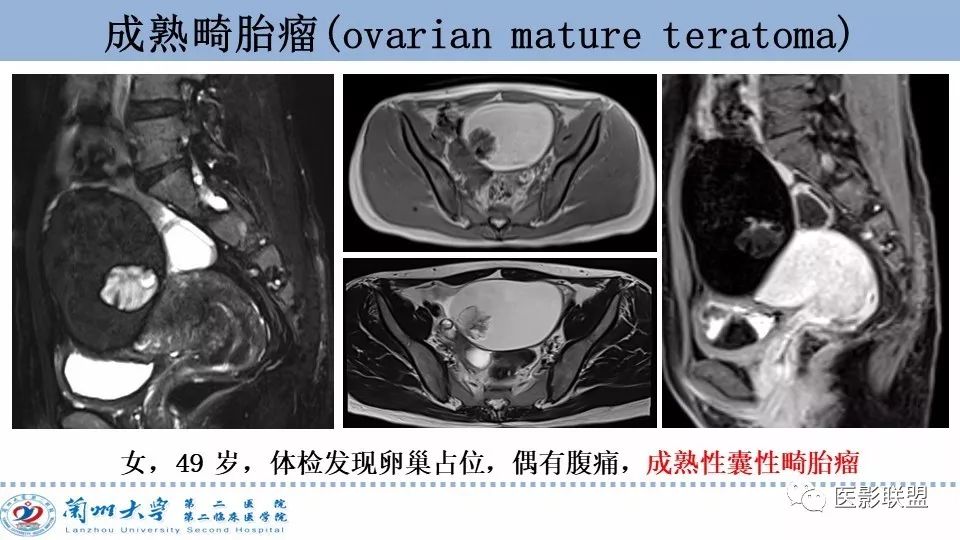 影像PPT - 【PPT】卵巢肿瘤MRI诊断-33