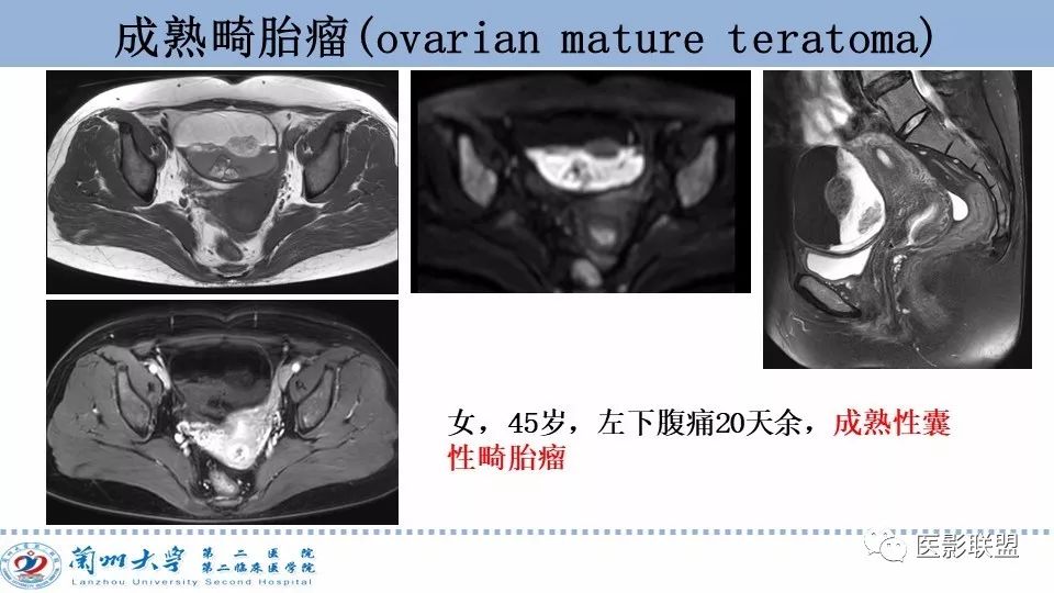 影像PPT - 【PPT】卵巢肿瘤MRI诊断-34
