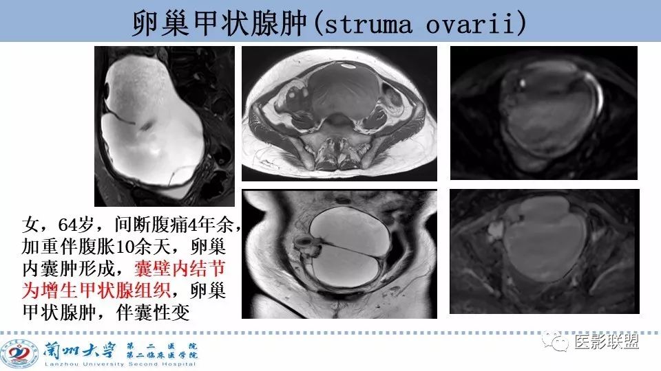影像PPT - 【PPT】卵巢肿瘤MRI诊断-40