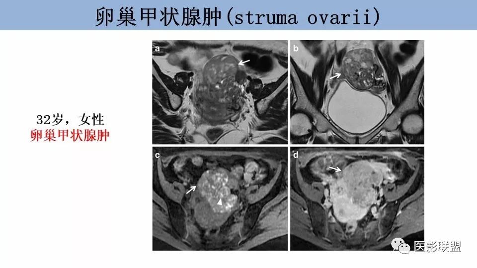 影像PPT - 【PPT】卵巢肿瘤MRI诊断-41