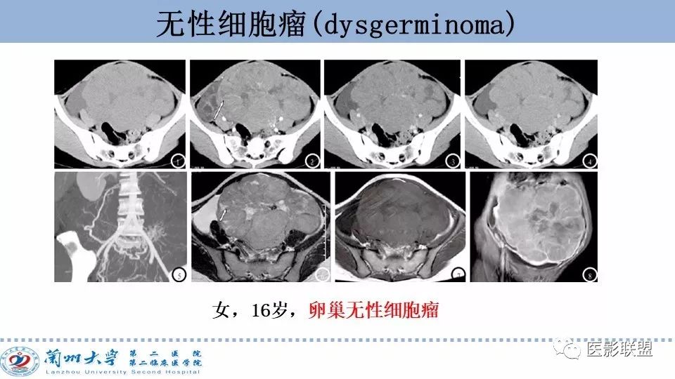 影像PPT - 【PPT】卵巢肿瘤MRI诊断-42